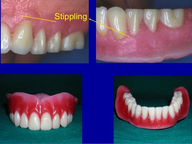 Immediate Partial Dentures Wauchula FL 33873